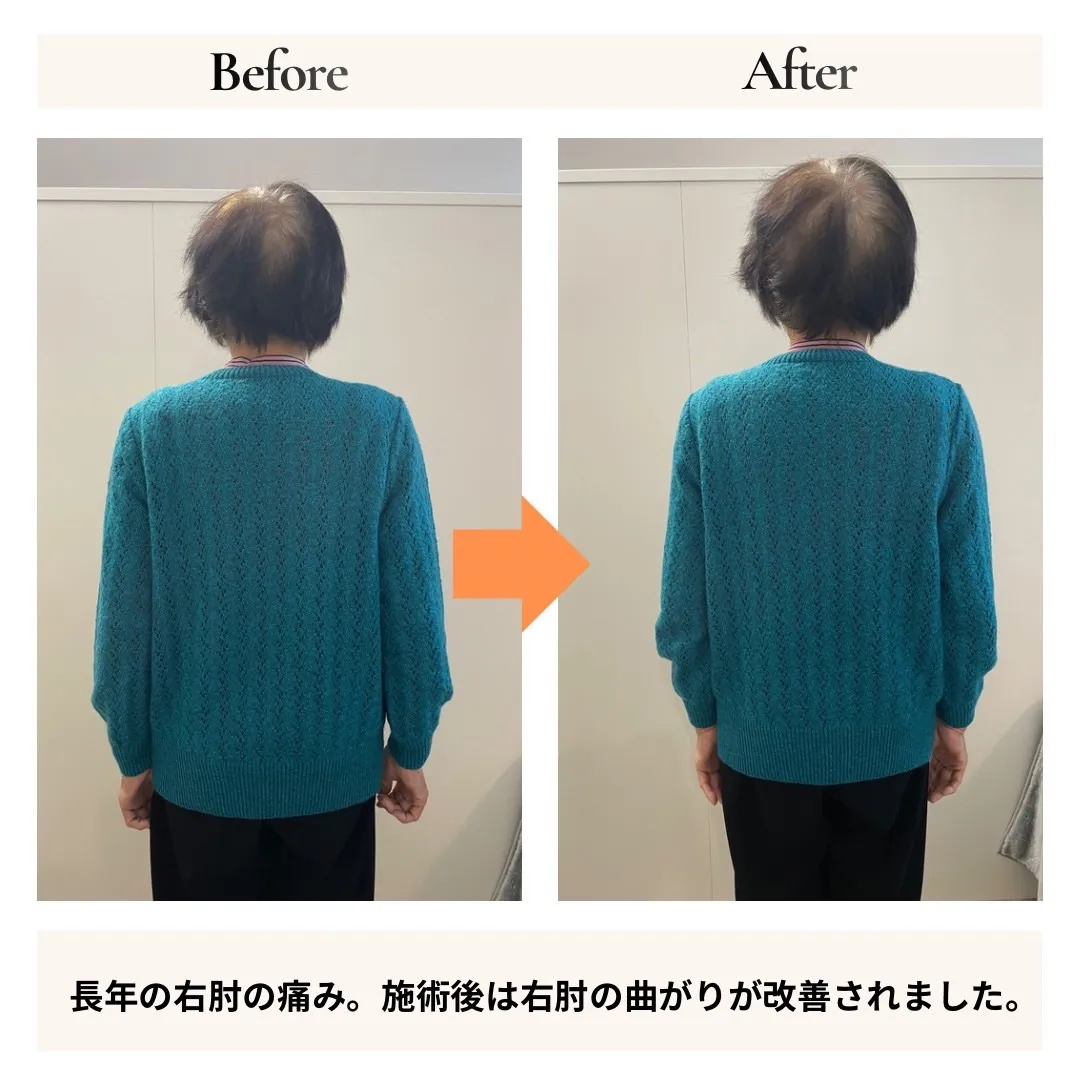 肘の痛み改善事例