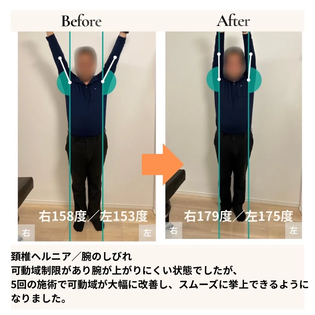 頸椎ヘルニア・腕のしびれ 正面