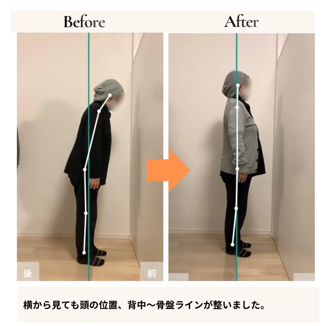 腰痛すべり症・変形性膝関節症 側面